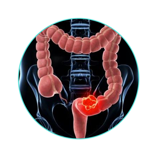 cancer, colon, colitis, sindrome colon irritable, dr. victor sanchez, cirujano, ciudad juarez