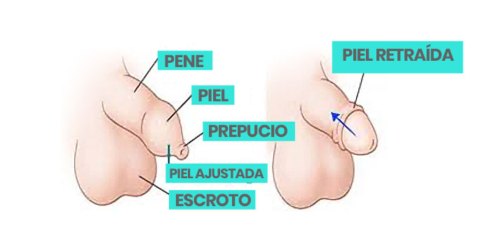 circuncision, dr. victor sanchez, cirujano, ciudad juarez