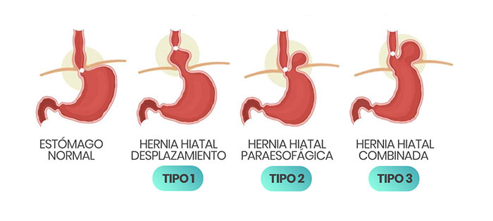 hernia hiatal, esofago, dr. victor sanchez, cirujano, ciudad juarez