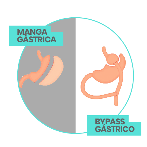 obesidad, manga gastrica bypass gastrico, doctor, cirujano, victor sanchez, ciudad juarez