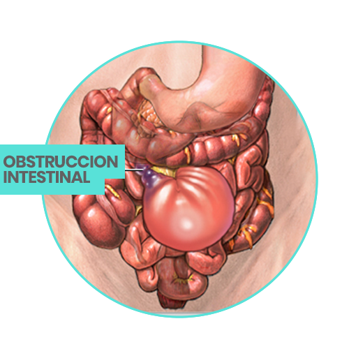 obstruccion intestinal, doctor, cirujano, victor sanchez, ciudad juarez
