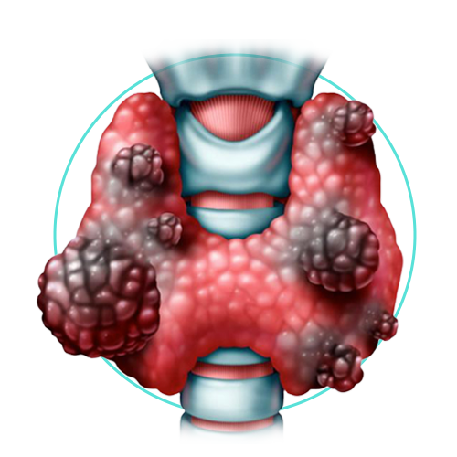 tiroides, tiroidectomia, dr. victor sanchez, cirujano, ciudad juarez