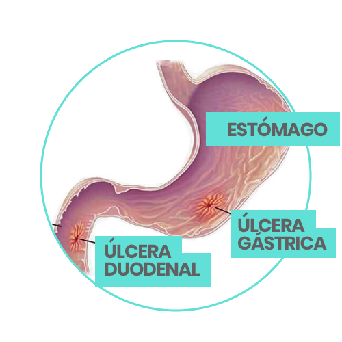 ulcera, gastritis, gastrica, doctor, cirujano, victor sanchez, ciudad juarez